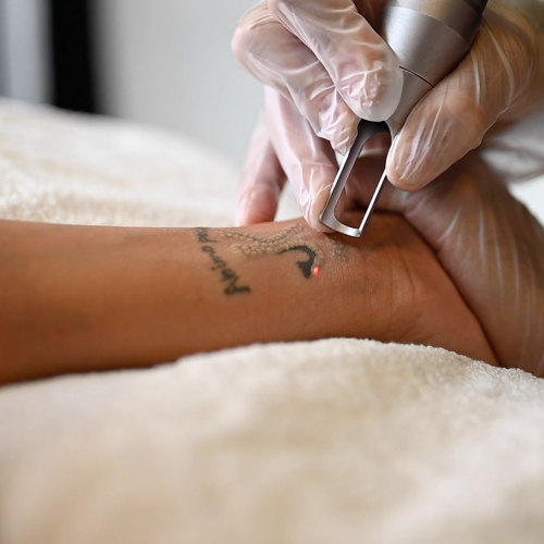 tatueringsborttagning